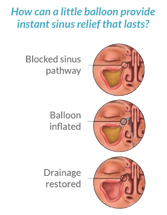 Sinuplasty